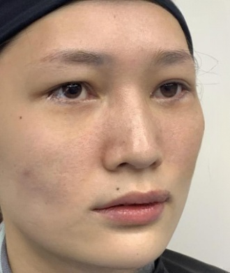 去眼袋手术