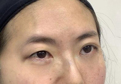 去眼袋手术