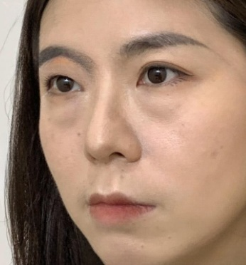 去眼袋手术