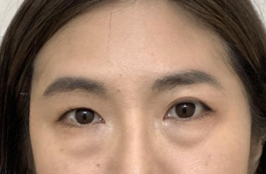 去眼袋手术