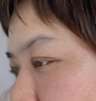 去眼袋手术