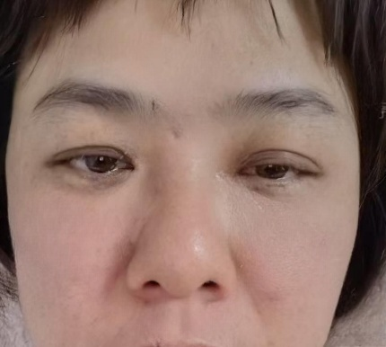 去眼袋手术