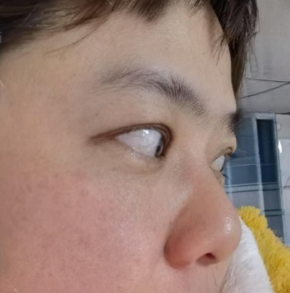 去眼袋手术