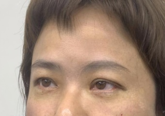 去眼袋手术
