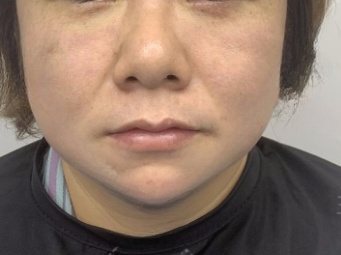 去眼袋手术