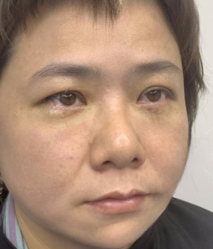 去眼袋手术