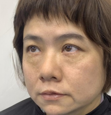 去眼袋手术