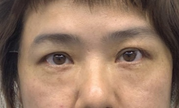 去眼袋手术