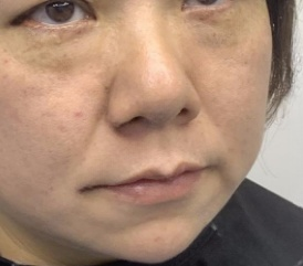 去眼袋手术