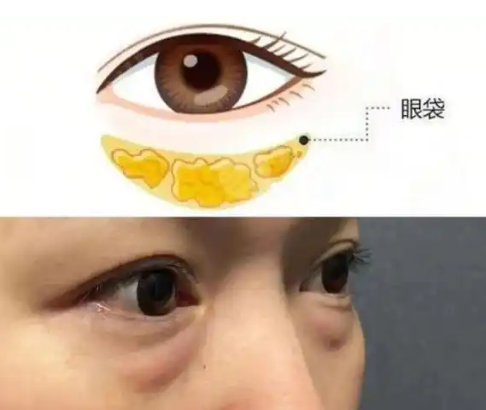 去眼袋手术