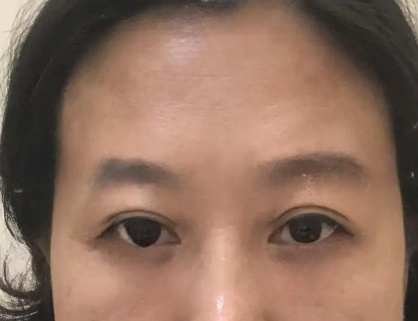 去眼袋手术