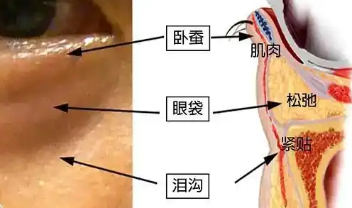 去眼袋手术