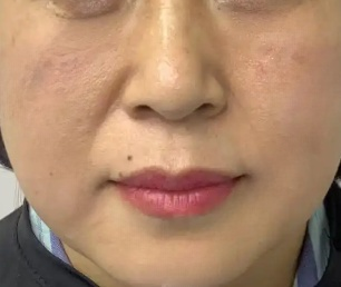 去眼袋手术