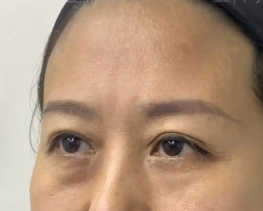 去眼袋手术