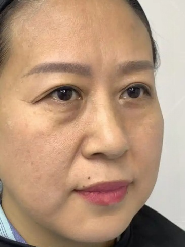 去眼袋手术