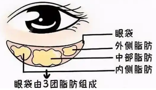 去眼袋手术
