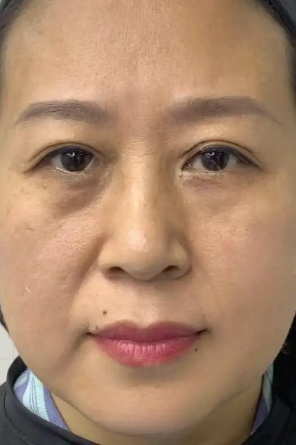 去眼袋手术