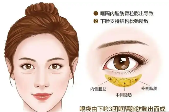 去眼袋手术