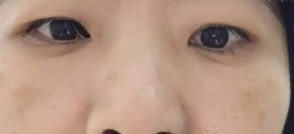去眼袋手术