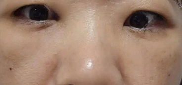 去眼袋手术