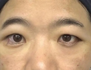 去眼袋手术