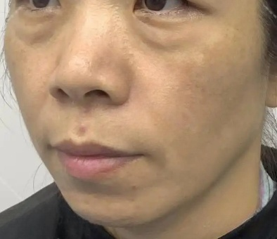 去眼袋手术