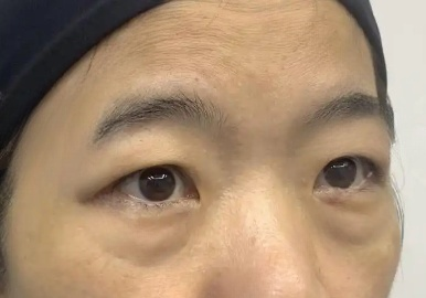 去眼袋手术