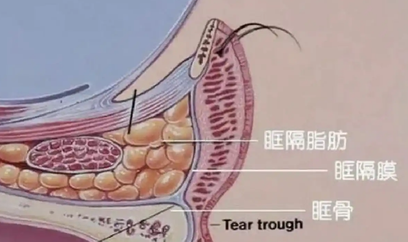 去眼袋手术