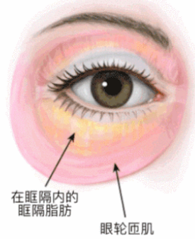 去眼袋手术