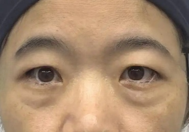 去眼袋手术