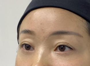 去眼袋手术