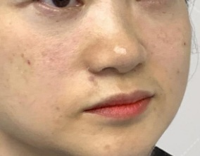 去眼袋手术