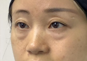 去眼袋手术