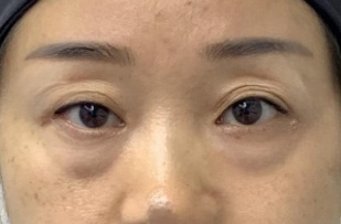 去眼袋手术