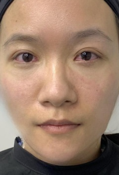 去眼袋手术
