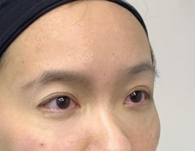 去眼袋手术