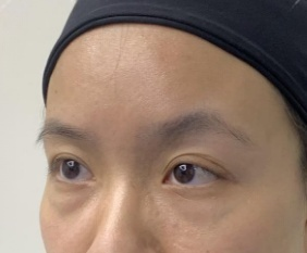 去眼袋手术