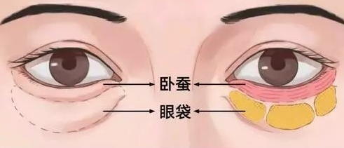 眼袋