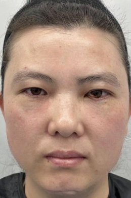 去眼袋手术