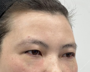 去眼袋手术