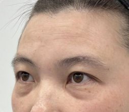 去眼袋手术