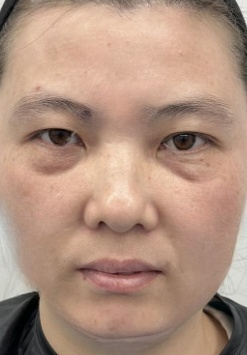 去眼袋手术