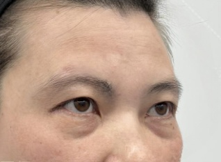 去眼袋手术