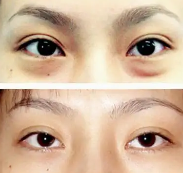 眼袋