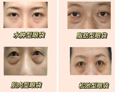 去眼袋手术