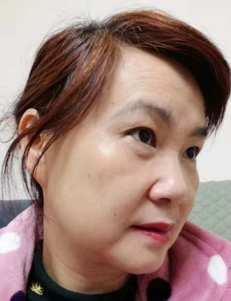 去眼袋手术