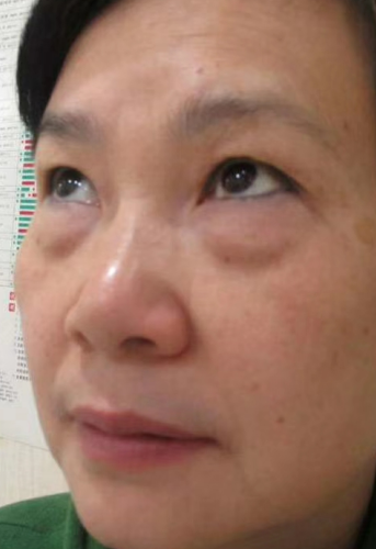 去眼袋手术