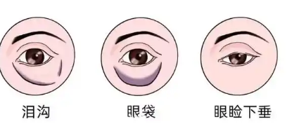 眼袋