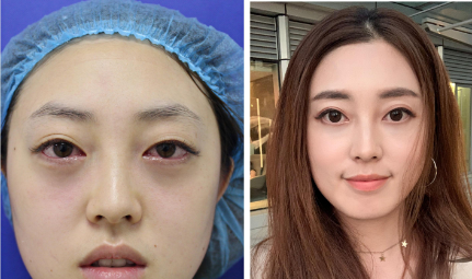 眼袋
