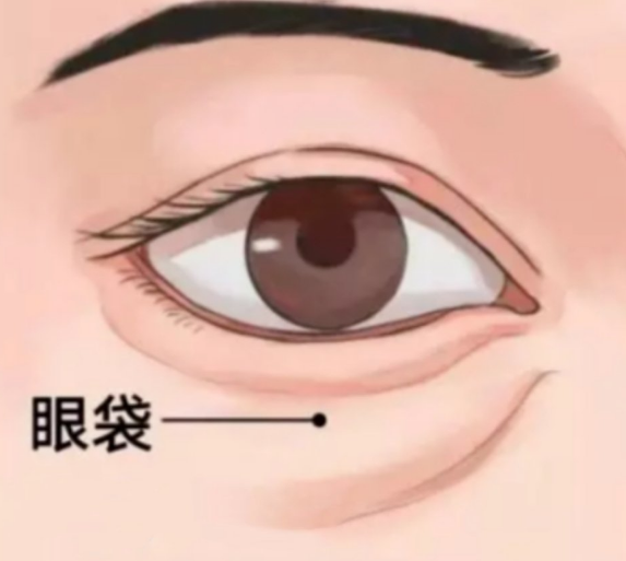 眼袋
